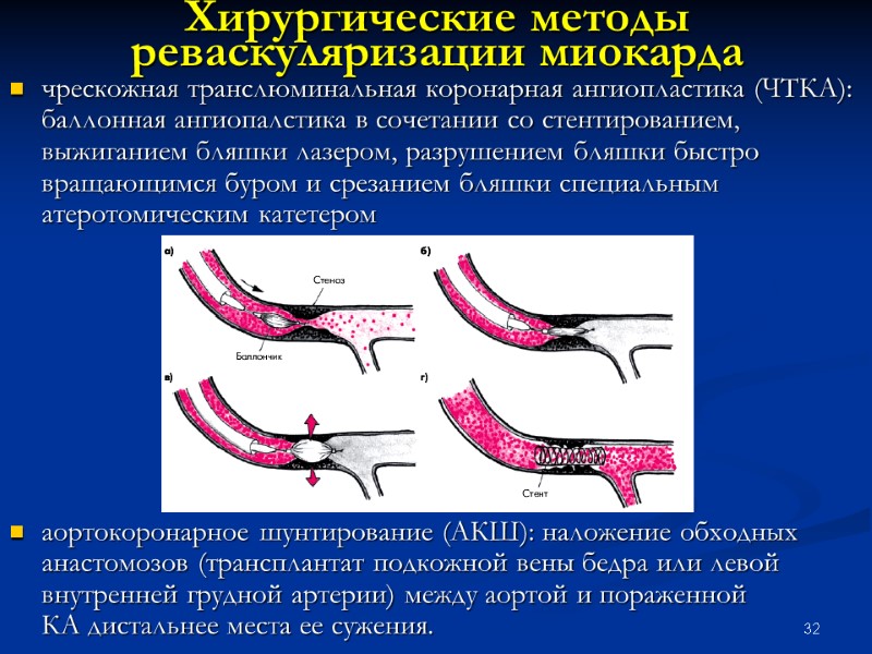 32 Хирургические методы реваскуляризации миокарда  чрескожная транслюминальная коронарная ангиопластика (ЧТКА): баллонная ангиопалстика в